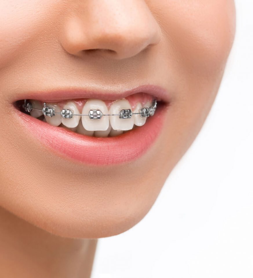 aparelho dental