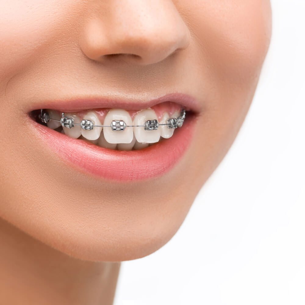 aparelho dental